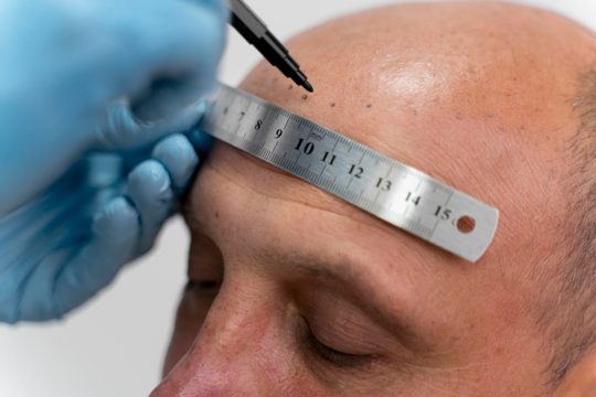 Male going through a follicular unit extraction process